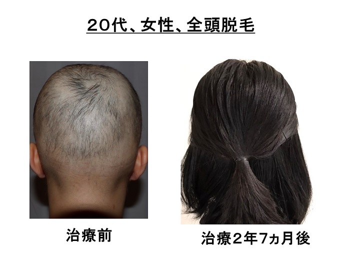 円形脱毛症　病院